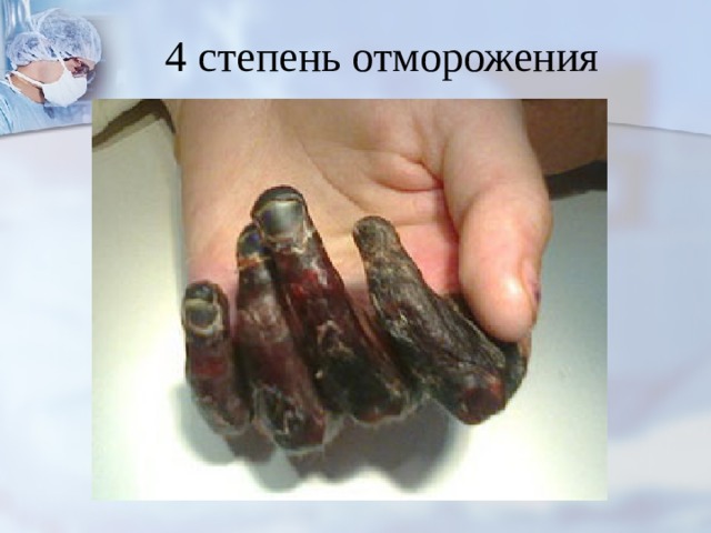 4 степень отморожения 