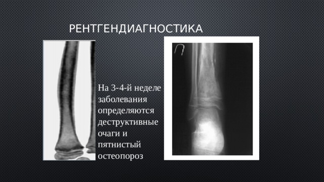 Рентгендиагностика На 3-4-й неделе заболевания определяются деструктивные очаги и пятнистый остеопороз 
