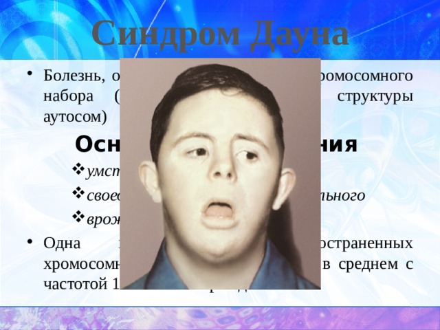 Синдром Дауна Болезнь, обусловленная аномалией хромосомного набора (изменением числа или структуры аутосом) Основные проявления умственная отсталость своеобразный внешний облик больного врожденные пороки развития умственная отсталость своеобразный внешний облик больного врожденные пороки развития умственная отсталость своеобразный внешний облик больного врожденные пороки развития Одна из наиболее распространенных хромосомных болезней, встречается в среднем с частотой 1 на 700 новорожденных.  