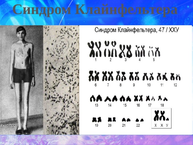 Синдром Клайнфельтера   