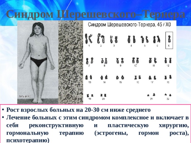 Синдром Шерешевского–Тернера Рост взрослых больных на 20-30 см ниже среднего Лечение больных с этим синдромом комплексное и включает в себя реконструктивную и пластическую хирургию, гормональную терапию (эстрогены, гормон роста), психотерапию) 