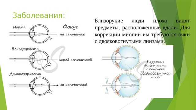 Заболевания: Близорукие люди плохо видят предметы, расположенные вдали. Для коррекции миопии им требуются очки с двояковогнутыми линзами. 