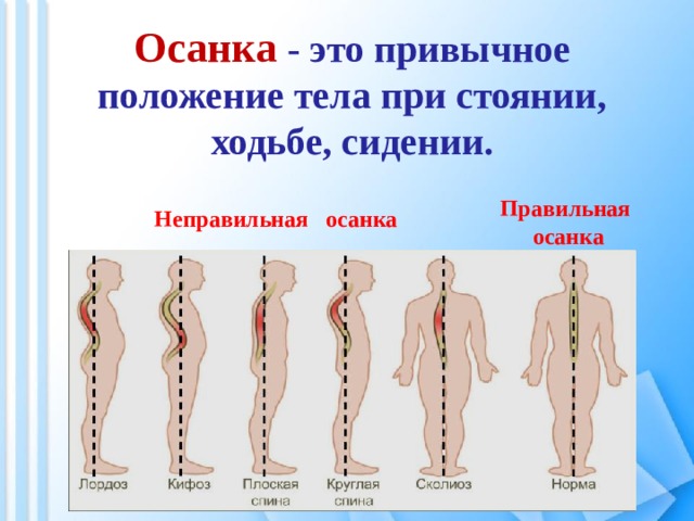 Осанка  - это привычное положение тела при стоянии, ходьбе, сидении. Правильная осанка Неправильная осанка 