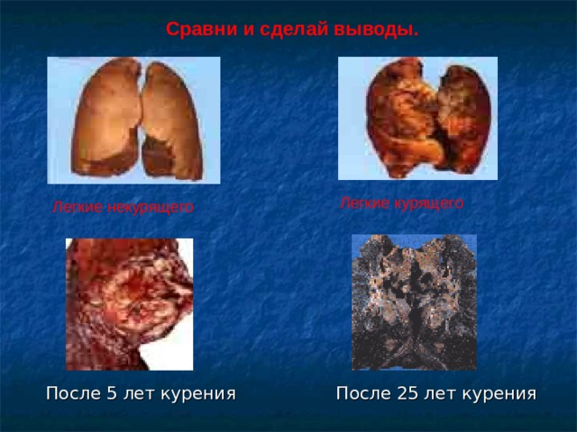Сравни и сделай выводы. Легкие курящего Легкие некурящего  После 5 лет курения После 25 лет курения 
