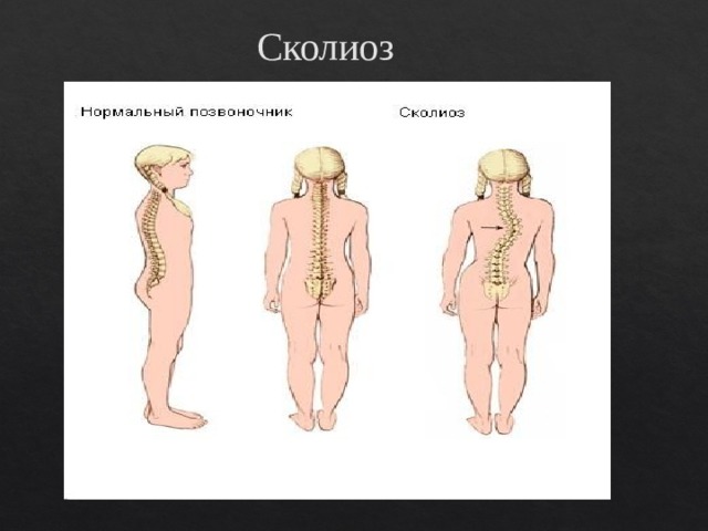 Сколиоз 