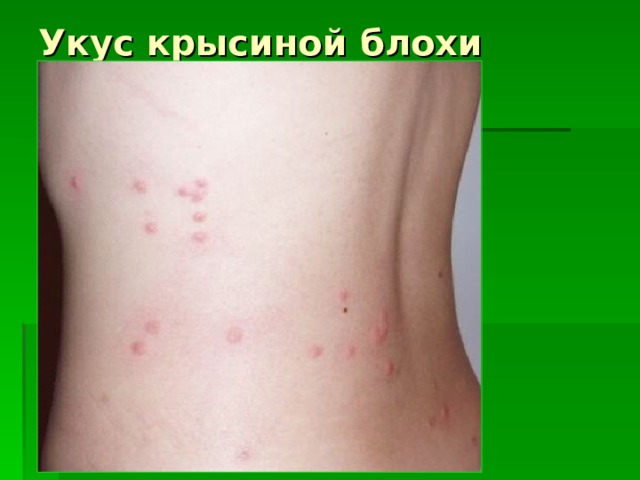Укус крысиной блохи 