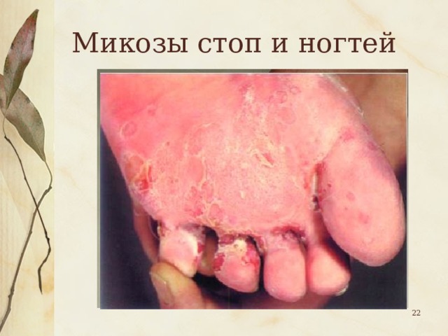 Микозы стоп и ногтей  