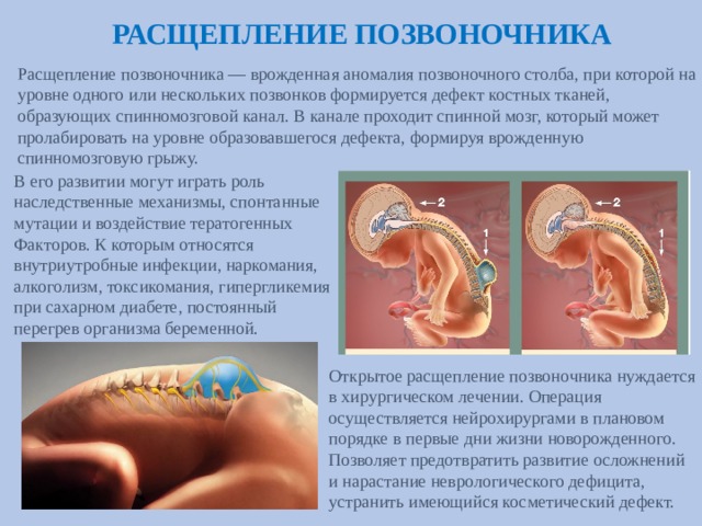 РАСЩЕПЛЕНИЕ ПОЗВОНОЧНИКА Расщепление позвоночника — врожденная аномалия позвоночного столба, при которой на уровне одного или нескольких позвонков формируется дефект костных тканей, образующих спинномозговой канал. В канале проходит спинной мозг, который может пролабировать на уровне образовавшегося дефекта, формируя врожденную спинномозговую грыжу. В его развитии могут играть роль  наследственные механизмы, спонтанные  мутации и воздействие тератогенных  Факторов. К которым относятся  внутриутробные инфекции, наркомания, алкоголизм, токсикомания, гипергликемия при сахарном диабете, постоянный  перегрев организма беременной. Открытое расщепление позвоночника нуждается в хирургическом лечении. Операция осуществляется нейрохирургами в плановом порядке в первые дни жизни новорожденного. Позволяет предотвратить развитие осложнений и нарастание неврологического дефицита, устранить имеющийся косметический дефект.   