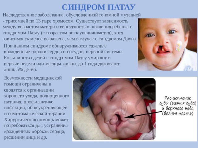 СИНДРОМ ПАТАУ Наследственное заболевание, обусловленной геномной мутацией - трисомией по 13 паре хромосом. Существует зависимость между возрастом матери и вероятностью рождения ребенка с синдромом Патау (с возрастом риск увеличивается), хотя зависимость менее выражена, чем в случае с синдромом Дауна.  При данном синдроме обнаруживаются тяжелые врожденные пороки сердца и сосудов, нервной системы. Большинство детей с синдромом Патау умирают в первые недели или месяцы жизни, до 1 года доживают лишь 5% детей.  Возможности медицинской помощи ограничены и сводятся к организации хорошего ухода, полноценного питания, профилактике инфекций, общеукрепляющей и симптоматической терапии. Хирургическая помощь может потребоваться для устранения врожденных пороков сердца, расщелин лица и др. 