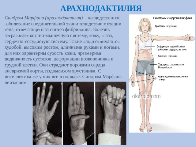 АРАХНОДАКТИЛИЯ Синдром Марфана (арахнодактилия) – наследственное заболевание соединительной ткани вследствие мутации гена, отвечающего за синтез фибриллина. Болезнь затрагивает костно-мышечную систему, кожу, глаза, сердечно-сосудистую систему. Такие люди отличаются худобой, высоким ростом, длинными руками и ногами, для них характерны сухость кожи, чрезмерная подвижность суставов, деформации позвоночника и грудной клетки. Они страдают пороками сердца, аневризмой аорты, подвывихом хрусталика. С интеллектом же у них все в порядке. Синдром Марфана неизлечим. 