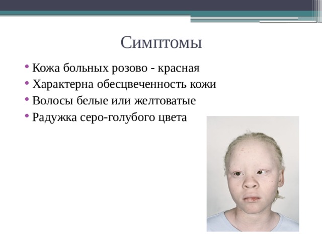 Симптомы Кожа больных розово - красная Характерна обесцвеченность кожи Волосы белые или желтоватые Радужка серо-голубого цвета 