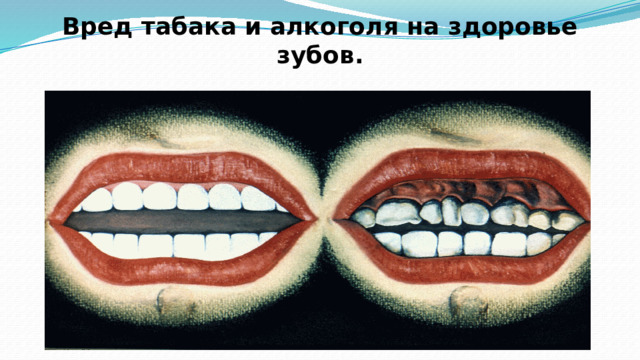 Вред табака и алкоголя на здоровье зубов. 