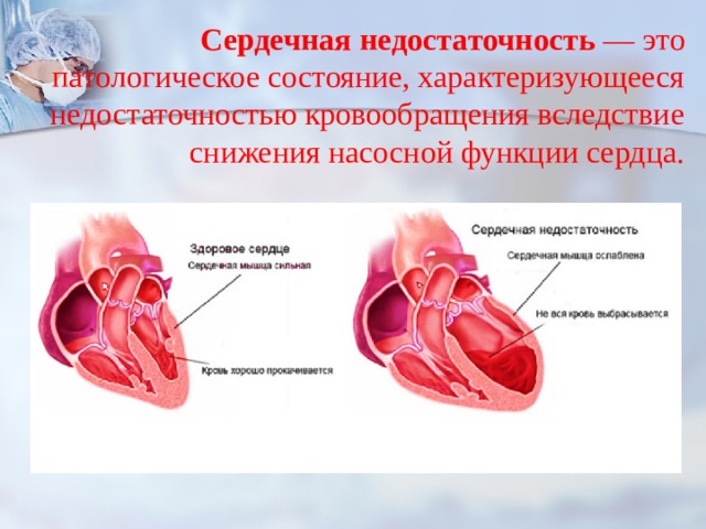 Сердечная недостаточность — это патологическое состояние, характеризующееся недостаточностью кровообращения вследствие снижения насосной функции сердца. 