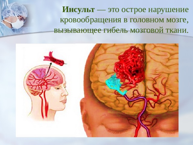 Инсульт — это острое нарушение кровообращения в головном мозге, вызывающее гибель мозговой ткани. 