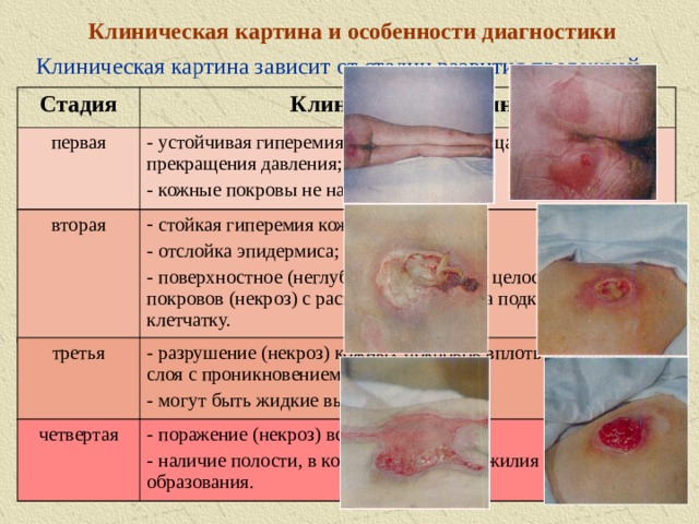 Клиническая картина и особенности диагностики Клиническая картина зависит от стадии развития пролежней. Стадия Клиническая картина первая  устойчивая гиперемия кожи, не проходящая после прекращения давления;  кожные покровы не нарушены. вторая  стойкая гиперемия кожи;  отслойка эпидермиса;  поверхностное (неглубокое) нарушение целостности кожных покровов (некроз) с распространением на подкожную клетчатку. третья  разрушение (некроз) кожных покровов вплоть до мышечного слоя с проникновением в мышцу;  могут быть жидкие выделения из раны. четвертая  поражение (некроз) всех мягких тканей;  наличие полости, в которой видны сухожилия и / или костные образования. 