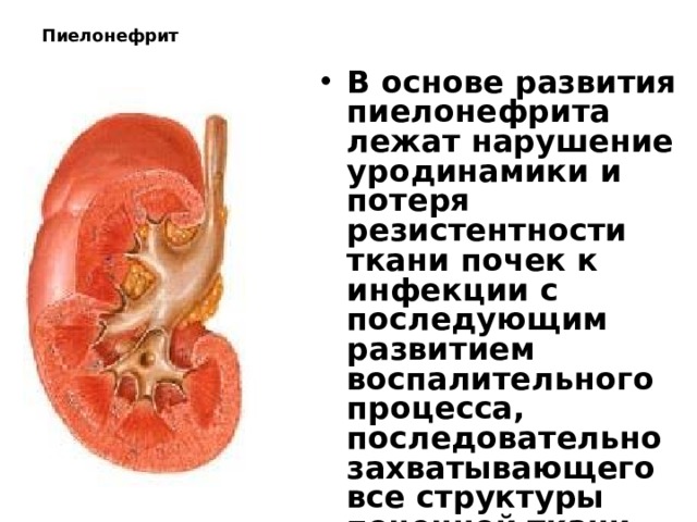 Пиелонефрит