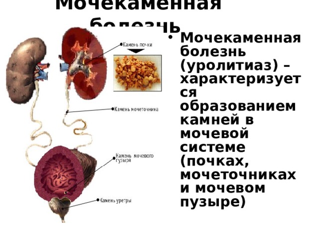 Мочекаменная болезнь
