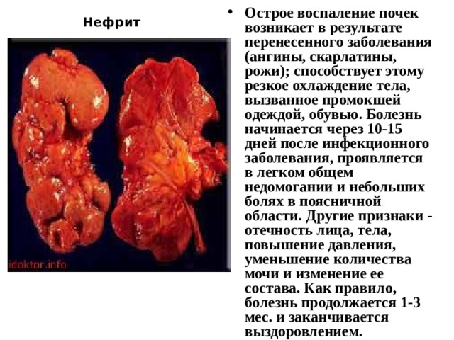 Острое воспаление почек возникает в результате перенесенного заболевания (ангины, скарлатины, рожи); способствует этому резкое охлаждение тела, вызванное промокшей одеждой, обувью. Болезнь начинается через 10-15 дней после инфекционного заболевания, проявляется в легком общем недомогании и небольших болях в поясничной области. Другие признаки - отечность лица, тела, повышение давления, уменьшение количества мочи и изменение ее состава. Как правило, болезнь продолжается 1-3 мес. и заканчивается выздоровлением.