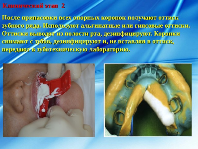 Клинический этап 2 После припасовки всех опорных коронок получают оттиск зубного ряда. Используют альгинатные или гипсовые оттиски. Оттиски выводят из полости рта, дезинфицируют. Коронки снимают с зубов, дезинфицируют и, не вставляя в оттиск, передают в зуботехническую лабораторию. 