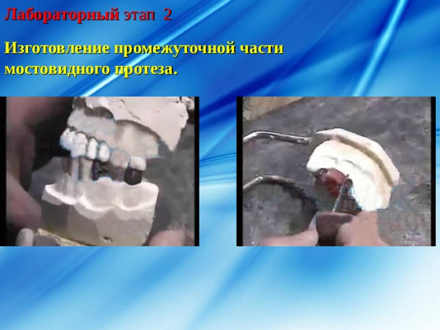 Лабораторный этап 2 Изготовление промежуточной части мостовидного протеза. 