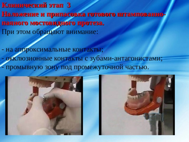 Клинический этап 3 Наложение и припасовка готового штампованно-паяного мостовидного протеза. При этом обращают внимание: - на аппроксимальные контакты; - окклюзионные контакты с зубами-антагонистами; - промывную зону под промежуточной частью. 