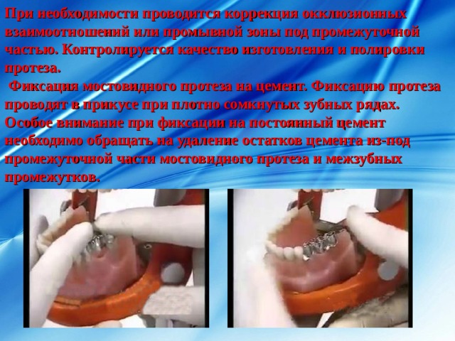 При необходимости проводится коррекция окклюзионных взаимоотношений или промывной зоны под промежуточной частью. Контролируется качество изготовления и полировки протеза.  Фиксация мостовидного протеза на цемент. Фиксацию протеза проводят в прикусе при плотно сомкнутых зубных рядах. Особое внимание при фиксации на постоянный цемент необходимо обращать на удаление остатков цемента из-под промежуточной части мостовидного протеза и межзубных промежутков. 