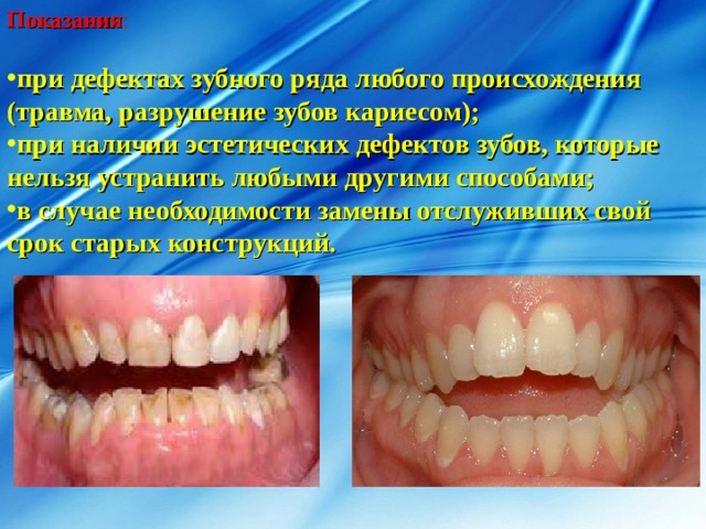 Показания : при дефектах зубного ряда любого происхождения (травма, разрушение зубов кариесом); при наличии эстетических дефектов зубов, которые нельзя устранить любыми другими способами; в случае необходимости замены отслуживших свой срок старых конструкций. 