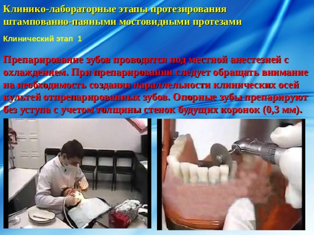 Клинико-лабораторные этапы протезирования штампованно-паяными мостовидными протезами Клинический этап 1 Препарирование зубов проводится под местной анестезией с охлаждением. При препарировании следует обращать внимание на необходимость создания параллельности клинических осей культей отпрепарированных зубов. Опорные зубы препарируют без уступа с учетом толщины стенок будущих коронок (0,3 мм). 
