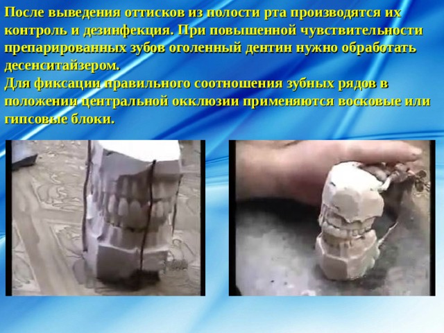 После выведения оттисков из полости рта производятся их контроль и дезинфекция. При повышенной чувствительности препарированных зубов оголенный дентин нужно обработать десенситайзером. Для фиксации правильного соотношения зубных рядов в положении центральной окклюзии применяются восковые или гипсовые блоки. 