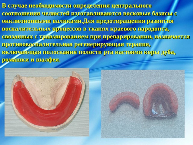В случае необходимости определения центрального соотношения челюстей изготавливаются восковые базисы с окклюзионными валиками.Для предотвращения развития воспалительных процессов в тканях краевого пародонта, связанных с травмированием при препарировании, назначается противовоспалительная регенерирующая терапия, включающая полоскания полости рта настоями коры дуба, ромашки и шалфея . 