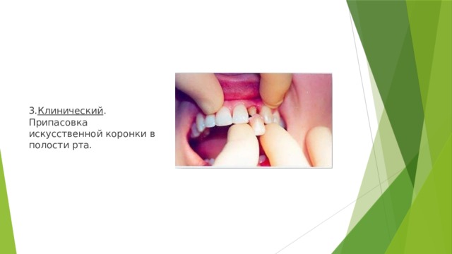 3. Клинический . Припасовка искусственной коронки в полости рта. 