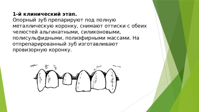 1-й клинический этап.  Опорный зуб препарируют под полную металлическую коронку, снимают оттиски с обеих челюстей альгинатными, силиконовыми, полисульфидными, полиэфирными массами. На отпрепарированный зуб изготавливают провизорную коронку.   