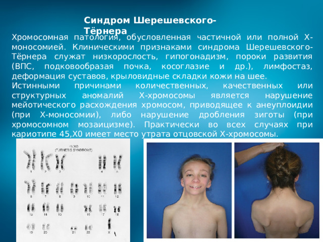 Синдром Шерешевского-Тёрнера Хромосомная патология, обусловленная частичной или полной Х-моносомией. Клиническими признаками синдрома Шерешевского-Тёрнера служат низкорослость, гипогонадизм, пороки развития (ВПС, подковообразая почка, косоглазие и др.), лимфостаз, деформация суставов, крыловидные складки кожи на шее. Истинными причинами количественных, качественных или структурных аномалий Х-хромосомы является нарушение мейотического расхождения хромосом, приводящее к анеуплоидии (при Х-моносомии), либо нарушение дробления зиготы (при хромосомном мозаицизме). Практически во всех случаях при кариотипе 45,Х0 имеет место утрата отцовской Х-хромосомы. 