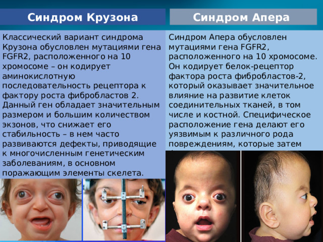 Синдром Крузона Синдром Апера Классический вариант синдрома Крузона обусловлен мутациями гена FGFR2, расположенного на 10 хромосоме – он кодирует аминокислотную последовательность рецептора к фактору роста фибробластов 2. Данный ген обладает значительным размером и большим количеством экзонов, что снижает его стабильность – в нем часто развиваются дефекты, приводящие к многочисленным генетическим заболеваниям, в основном поражающим элементы скелета.  Синдром Апера обусловлен мутациями гена FGFR2, расположенного на 10 хромосоме. Он кодирует белок-рецептор фактора роста фибробластов-2, который оказывает значительное влияние на развитие клеток соединительных тканей, в том числе и костной. Специфическое расположение гена делают его уязвимым к различного рода повреждениям, которые затем фенотипически проявляются наследственными заболеваниями. 