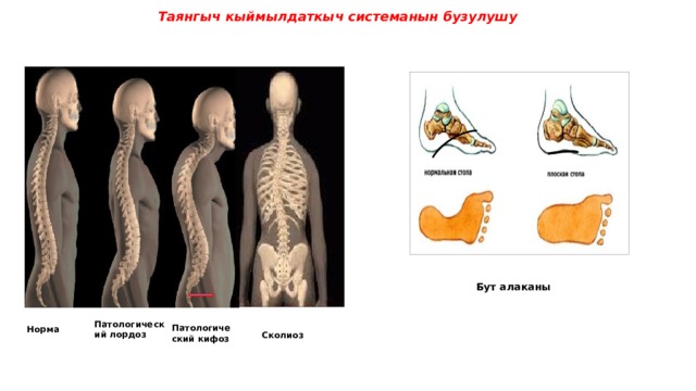Таянгыч кыймылдаткыч системанын бузулушу  Бут алаканы Патологический лордоз Патологический кифоз Норма Сколиоз 