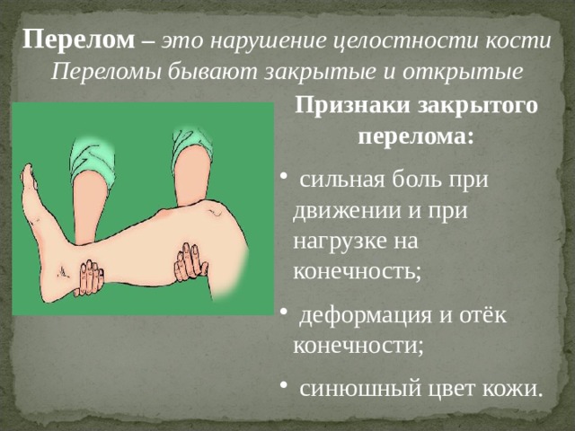 Перелом – это нарушение целостности кости Переломы бывают закрытые и открытые Признаки закрытого перелома:  сильная боль при движении и при нагрузке на конечность;  деформация и отёк конечности;  синюшный цвет кожи. 