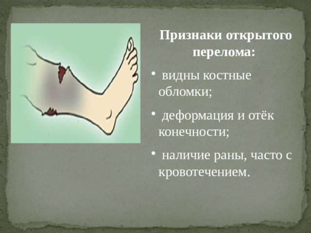 Признаки открытого перелома:  видны костные обломки;  деформация и отёк конечности;  наличие раны, часто с кровотечением. 