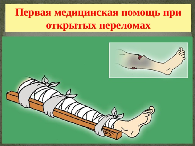 Первая медицинская помощь при открытых переломах 