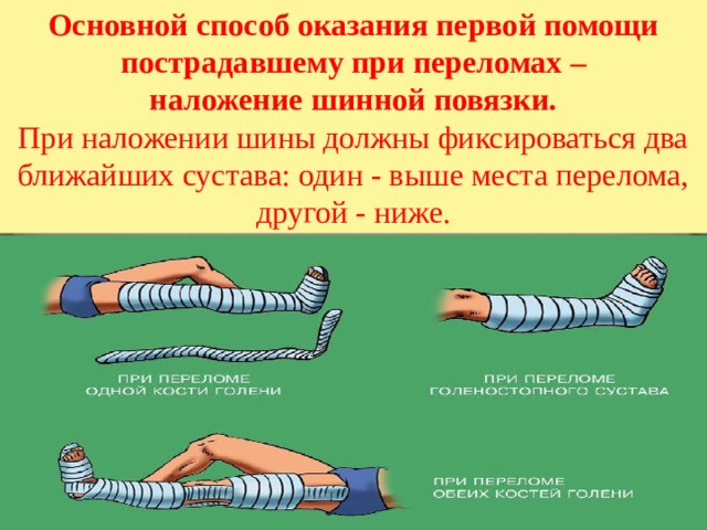 Основной способ оказания первой помощи пострадавшему при переломах –  наложение шинной повязки. При наложении шины должны фиксироваться два ближайших сустава: один - выше места перелома, другой - ниже. 