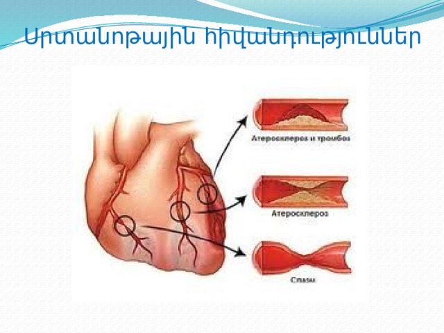 Սրտանոթային հիվանդություններ 