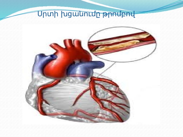 Սրտի խցանումը թրոմբով 