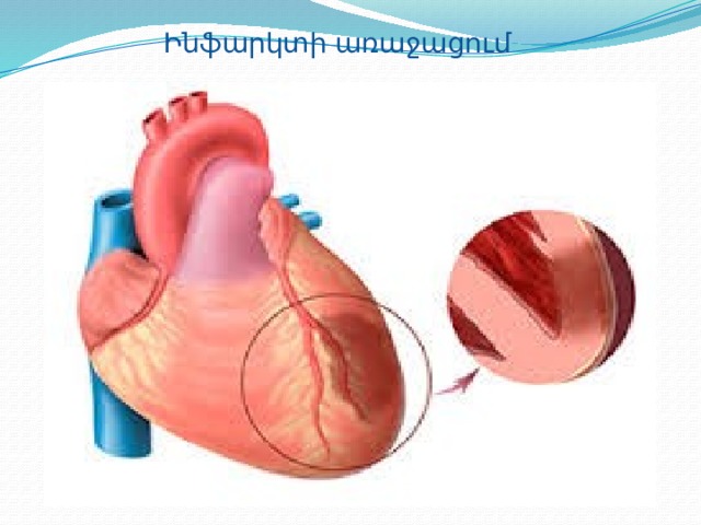 Ինֆարկտի առաջացում 