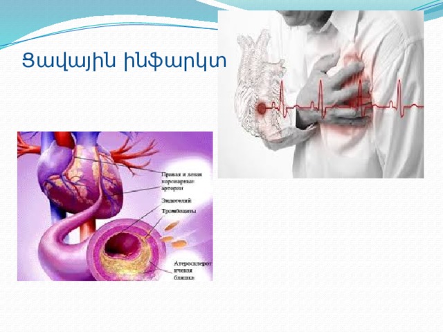 Ցավային ինֆարկտ 