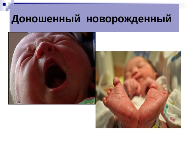 Доношенный новорожденный 