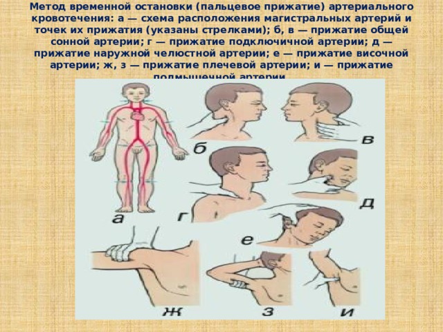 Метод временной остановки (пальцевое прижатие) артериального кровотечения: а — схема расположения магистральных артерий и точек их прижатия (указаны стрелками); б, в — прижатие общей сонной артерии; г — прижатие подключичной артерии; д — прижатие наружной челюстной артерии; е — прижатие височной артерии; ж, з — прижатие плечевой артерии; и — прижатие подмышечной артерии. 