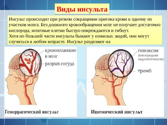 Виды инсульта Инсульт происходит при резком сокращении притока крови к одному из участков мозга. Без должного кровообращения мозг не получает достаточно кислорода, мозговые клетки быстро повреждаются и гибнут.  Хотя по большей части инсульты бывают у пожилых людей, они могут случиться в любом возрасте. Инсульт разделяют на 
