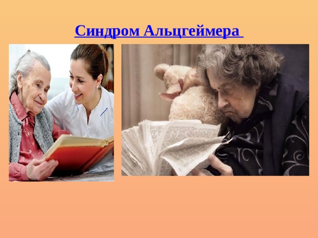 Синдром Альцгеймера 