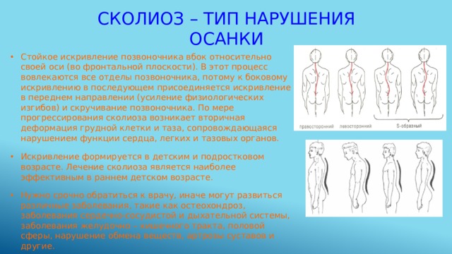 Сколиоз – тип нарушения осанки Стойкое искривление позвоночника вбок относительно своей оси (во фронтальной плоскости). В этот процесс вовлекаются все отделы позвоночника, потому к боковому искривлению в последующем присоединяется искривление в переднем направлении (усиление физиологических изгибов) и скручивание позвоночника. По мере прогрессирования сколиоза возникает вторичная деформация грудной клетки и таза, сопровождающаяся нарушением функции сердца, легких и тазовых органов. Искривление формируется в детским и подростковом возрасте. Лечение сколиоза является наиболее эффективным в раннем детском возрасте. Нужно срочно обратиться к врачу, иначе могут развиться различные заболевания, такие как остеохондроз, заболевания сердечно-сосудистой и дыхательной системы, заболевания желудочно – кишечного тракта, половой сферы, нарушение обмена веществ, артрозы суставов и другие. 