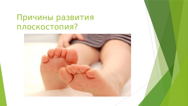 Причины развития плоскостопия?   