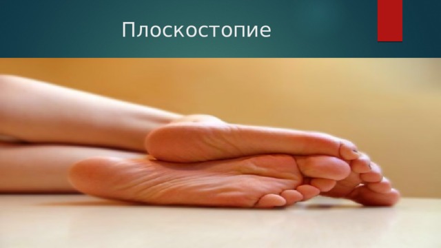 Плоскостопие 